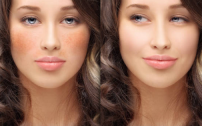 Hyperpigmentation:Types and Treatments